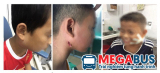 Vi khuẩn ăn thịt người | Ca bệnh whitmore đang ngày một gia tăng